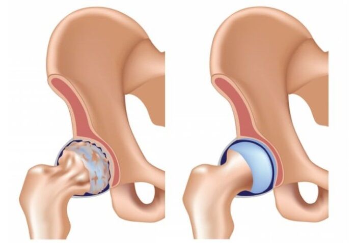 healthy and destroyed hip joints