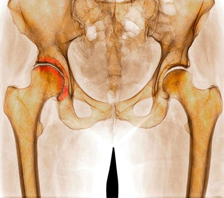 hip joint inflammation as a cause of pain