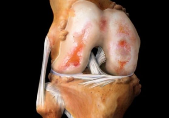 Cyst