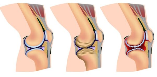 The level of deformation of the knee joint