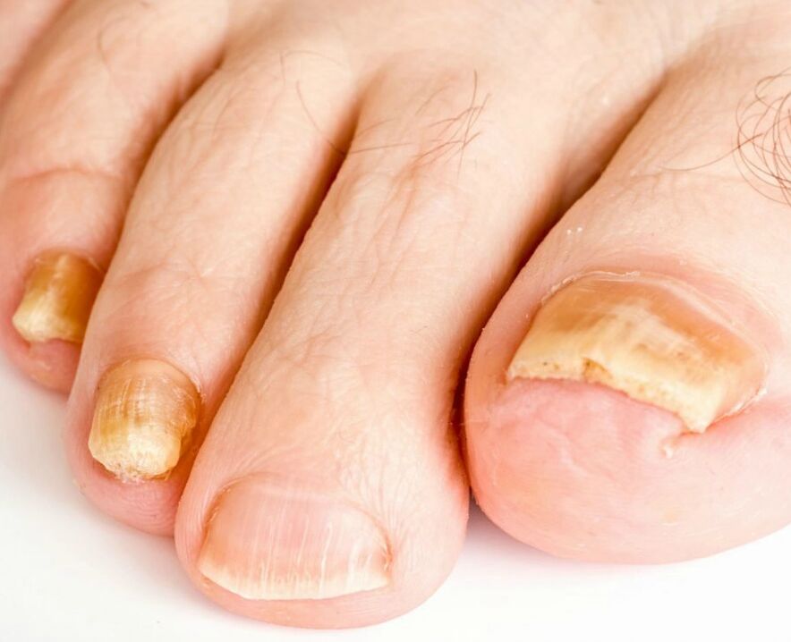 fungus on nails