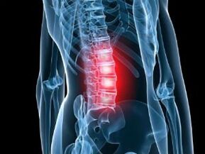 Lumbar spinal osteochondrosis