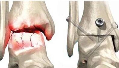 Knee arthrosis surgery treatment