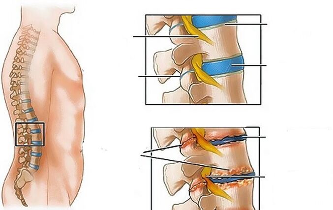 Osteochondrosis of the lumbar area