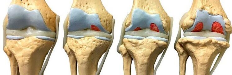 stage of knee arthrosis
