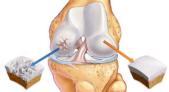 healthy cartilage and cartilage affected by arthrosis