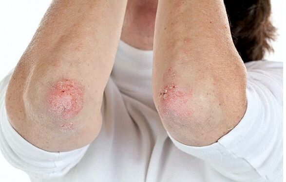 People with psoriasis are prone to psoriatic arthritis