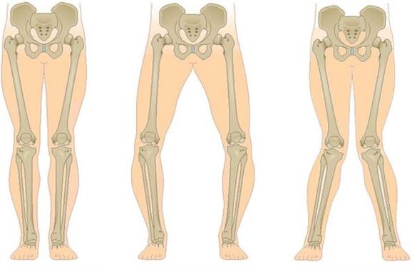 type of arthrosis