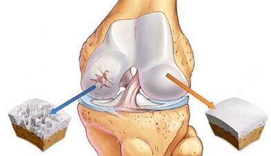 Causes -Development of joint arthrosis
