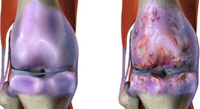The main difference of arthritis and arthrosis