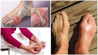 What is the arthritis of the joint